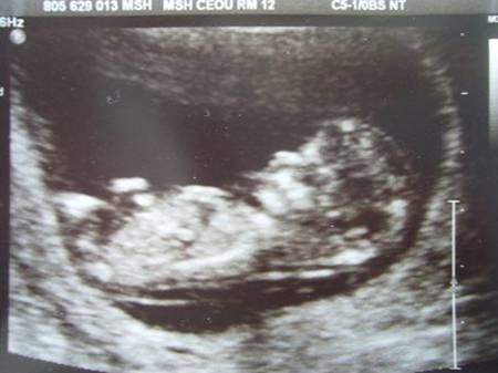 nt检查了有必要查糖耐吗,nt检查37岁有必要检查吗