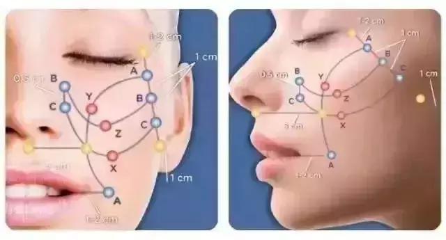 线雕提升的效果图,线雕青春定格术多久消肿