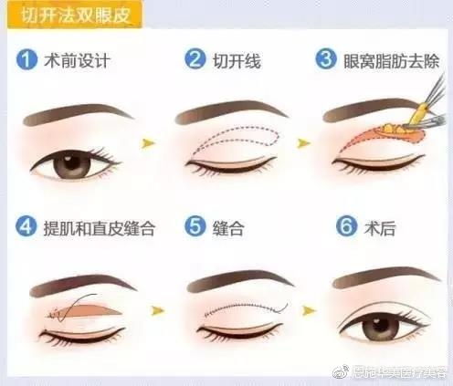 眼部整形常见的15个问题,眼部护理要避开九大误区