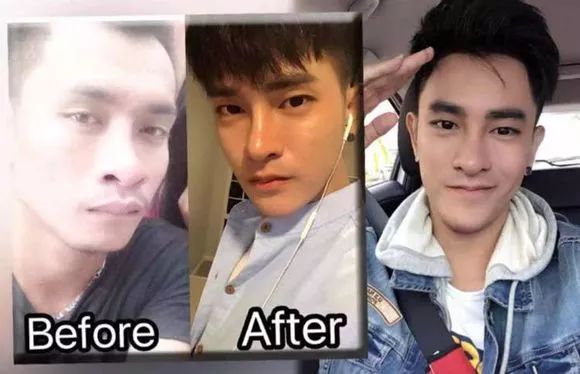 丑男整容变帅哥对比照,长得太丑了找不到老婆