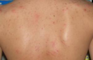 后背经常起疙瘩痘痘怎么回事,后背皮肤会长疙瘩