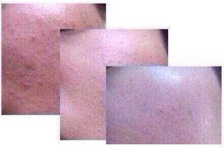 光子嫩肤痘印去不掉啊,做完光子嫩肤痘印加深