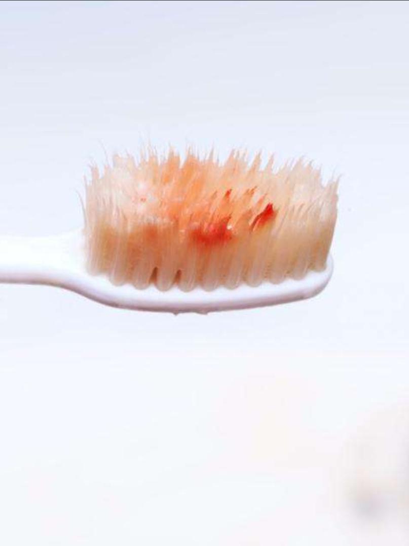 早期牙周病的症状,什么是牙周病及症状表现