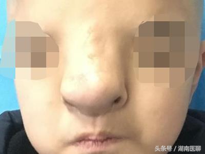 12岁小孩因长相太怪无法入学,尝试整形手术成功,父母热泪盈眶!
