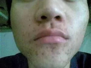 怎么去除脸上的黑痘印红痘印,教你轻松祛除痘印的方法