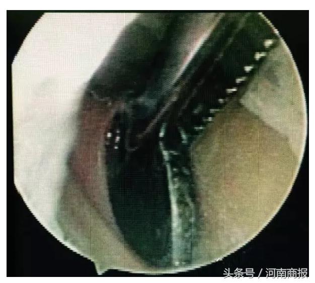 郑州一男童“蛋蛋”疼,送医后为时已晚需要切除!