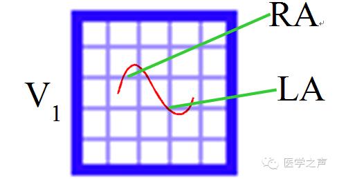 心电图课堂第22期,儿童心电图左室肥大怎么回事