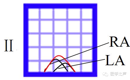 心电图课堂第22期,儿童心电图左室肥大怎么回事