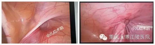 宝宝疝气手术疤痕,成人疝气修补手术疤痕