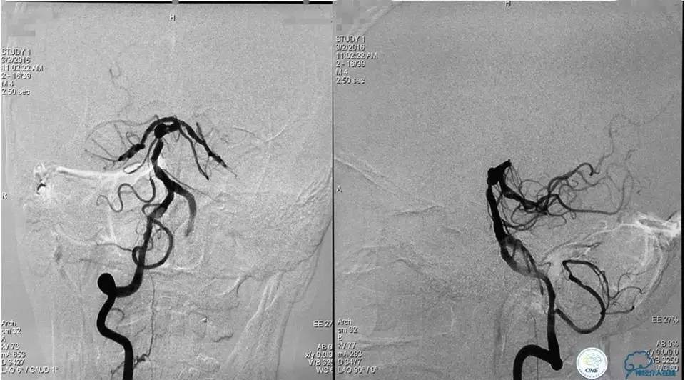 脑动脉瘤并颈动脉狭窄怎么治疗,脑动脉血管狭窄介入治疗效果好吗