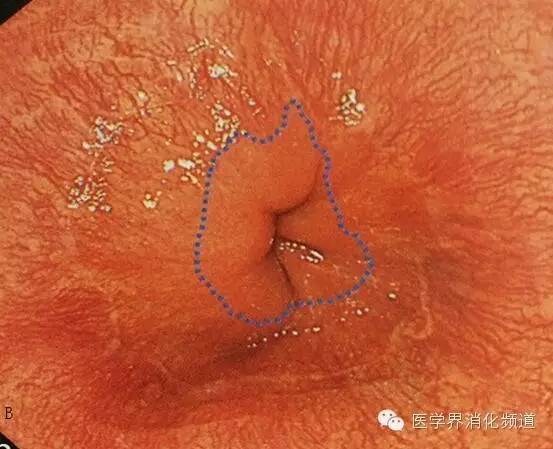 barrett食管的症状是什么,barrett食管是什么意思