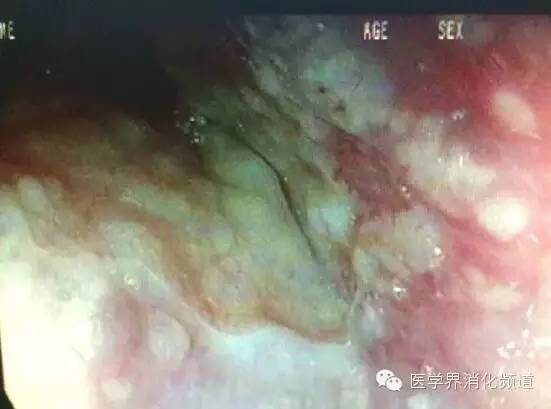 barrett食管的症状是什么,barrett食管是什么意思