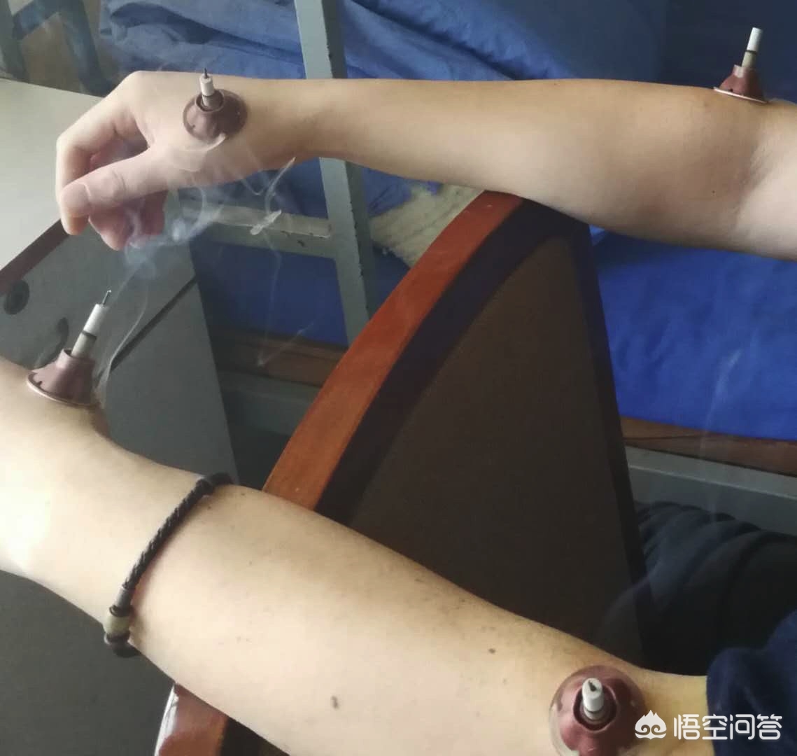 面瘫面神经炎最有效的方法,治疗周围神经性面瘫的土方