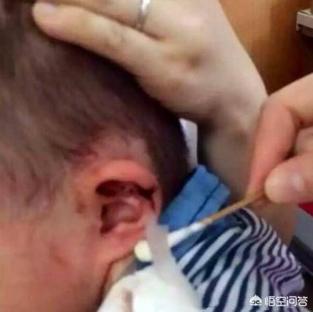 小孩子耳朵有异物怎么弄出来,孩子耳朵里进小东西该怎么办
