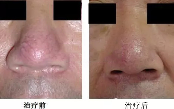 酒渣鼻怎么改善学生党,酒渣鼻严重怎么彻底治疗