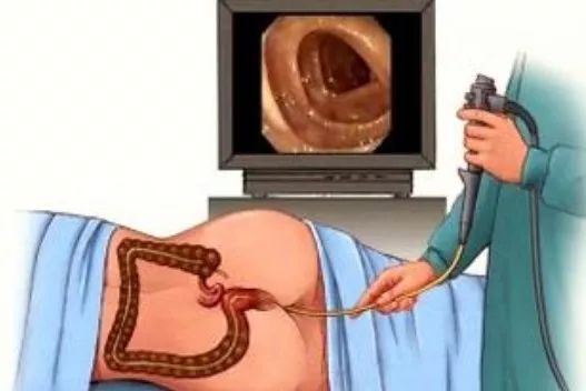 收起你的砍屎刀，教你痛痛快快拉粑粑！