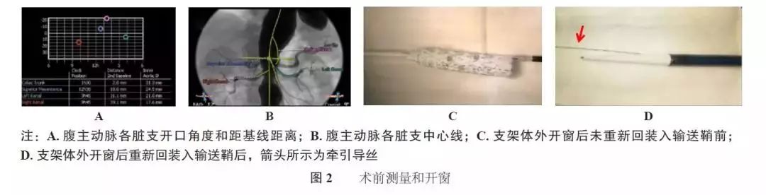 evar手术,胸主动脉夹层开窗手术