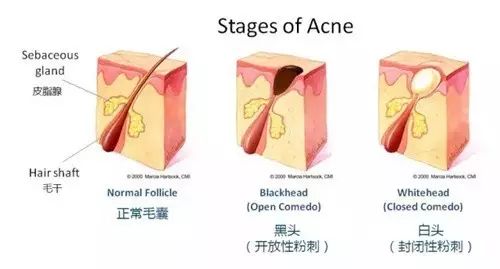 真假黑头教你如何正确去黑头,如何辨别黑头以及正确使用产品