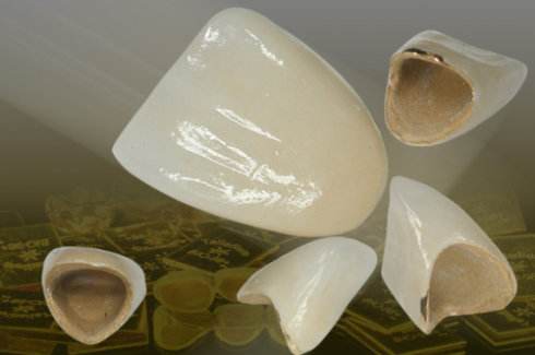 怎样选择烤瓷牙冠颜色,如何选择烤瓷牙和全瓷牙