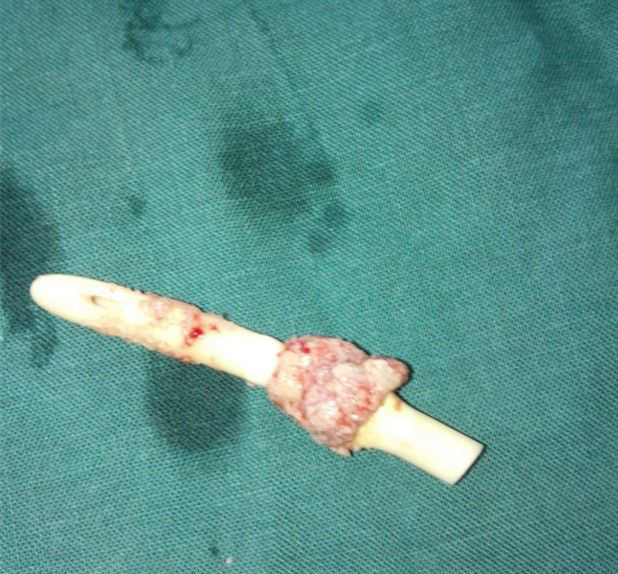 老年人拔尿管后尿不出来怎么回事,刚拔了尿管怎么更好恢复排尿功能