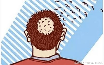 梅毒斑秃脱发,怎么分辨是梅毒性脱发还是斑秃