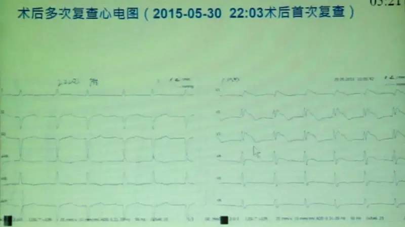 brugada三种形态的心电图,心电图查出brugada混合型严重吗