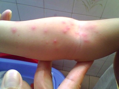 小孩皮肤过敏怎么办教你一招解决,小孩皮肤过敏怎么办最快方法