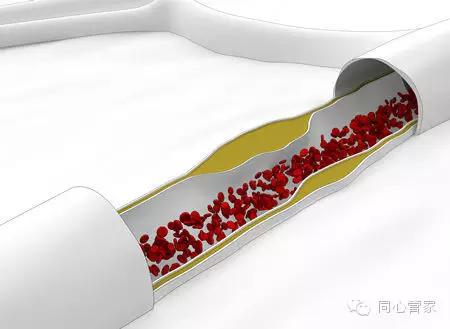 心血管软斑块危险,心血管软斑块和硬斑块的区别