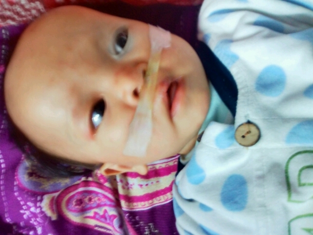 婴儿单纯先天裂唇7毫米,先天性腭裂是什么