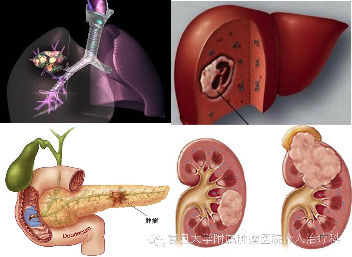 冰火两重天治疗,冰火两重天中医