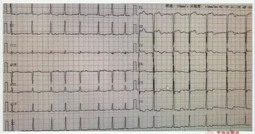 郑大一附院心血管内科专家陈英伟,房颤的治疗策略及进展