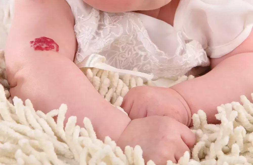 株洲1岁宝宝手臂上长了个“草莓”，急坏家长！