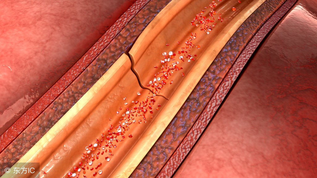 脑梗塞后遗症憋不住尿怎么办,多发性脑梗塞后遗症吃什么药
