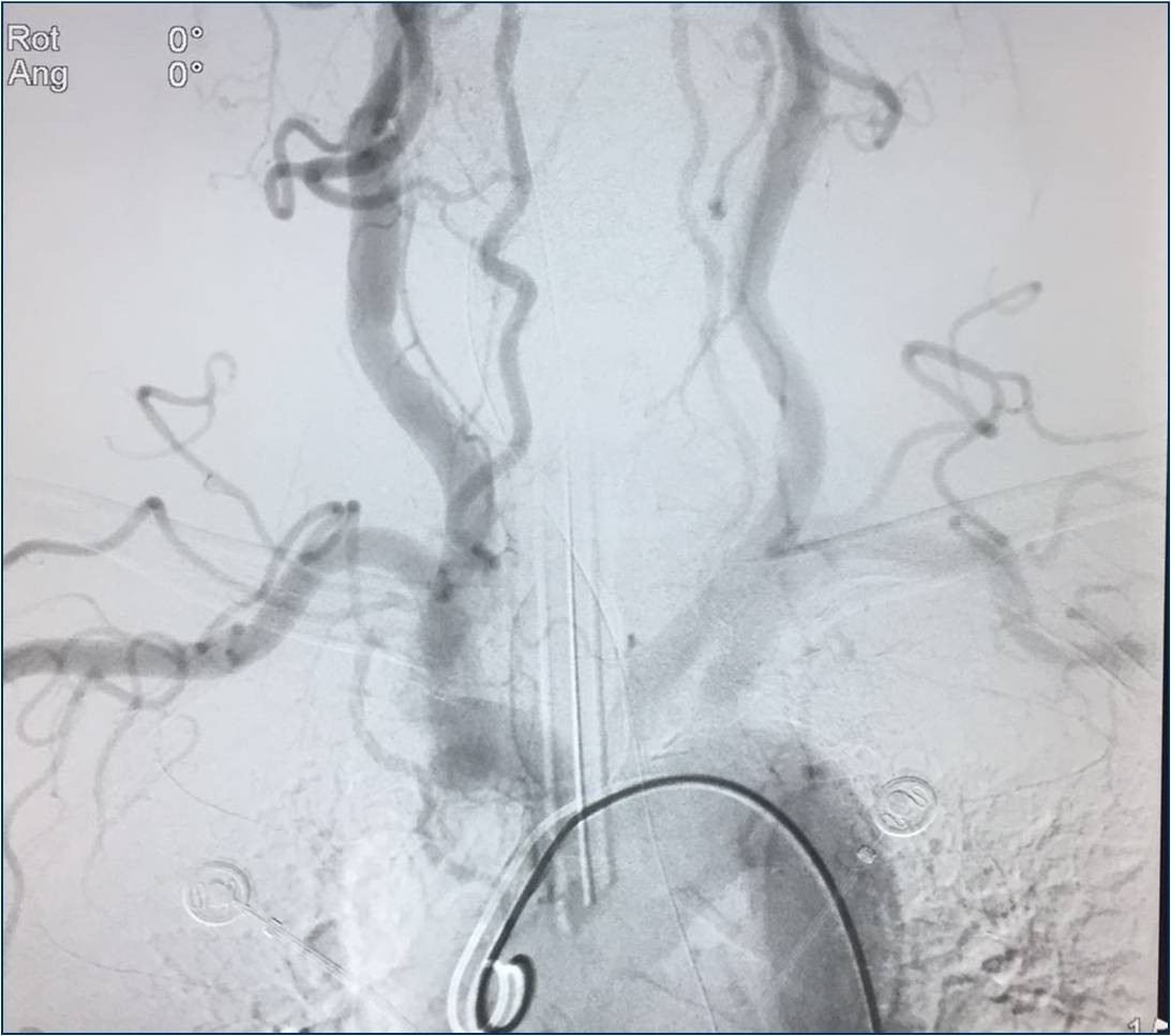 取栓慢性闭塞如何避免血栓逃逸,急性大脑中动脉栓塞取栓时间