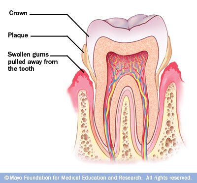 牙周病，三分治，七分“养”