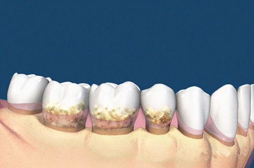 中老年牙龈出血是怎么回事,老年人牙龈出血吃什么药治疗