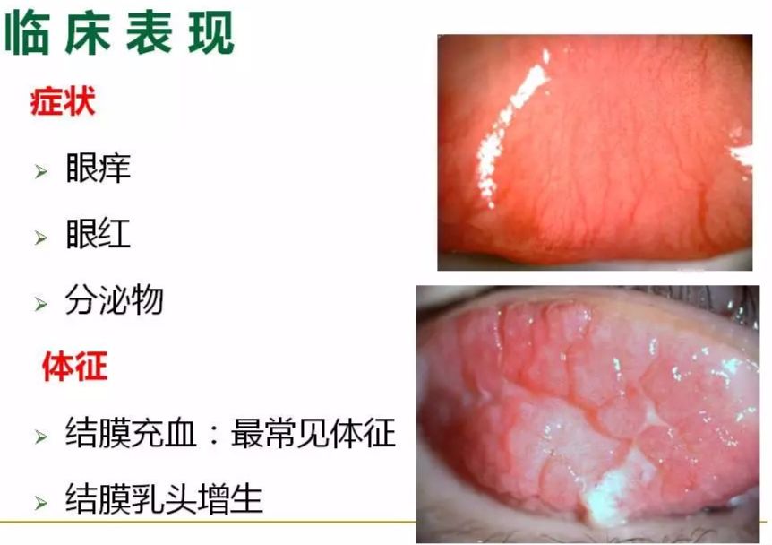 眼周过敏中医治疗,眼周过敏的症状图片