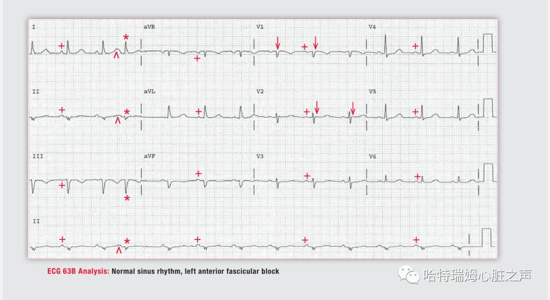 「读心有术」329期:电轴极度左偏,病因有两种