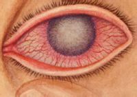 割双眼皮开眼角眼睛会变大吗,开眼角眼球充血怎么快速消除