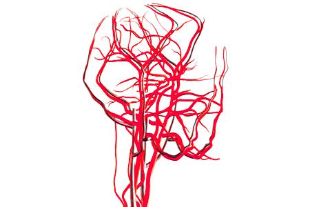 动脉瘤破裂大面积脑梗死后遗症,破裂的脑动脉瘤治愈几率