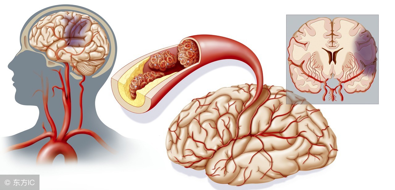脑梗塞引起的头晕头疼怎么治疗,脑梗塞头疼的缓解方法
