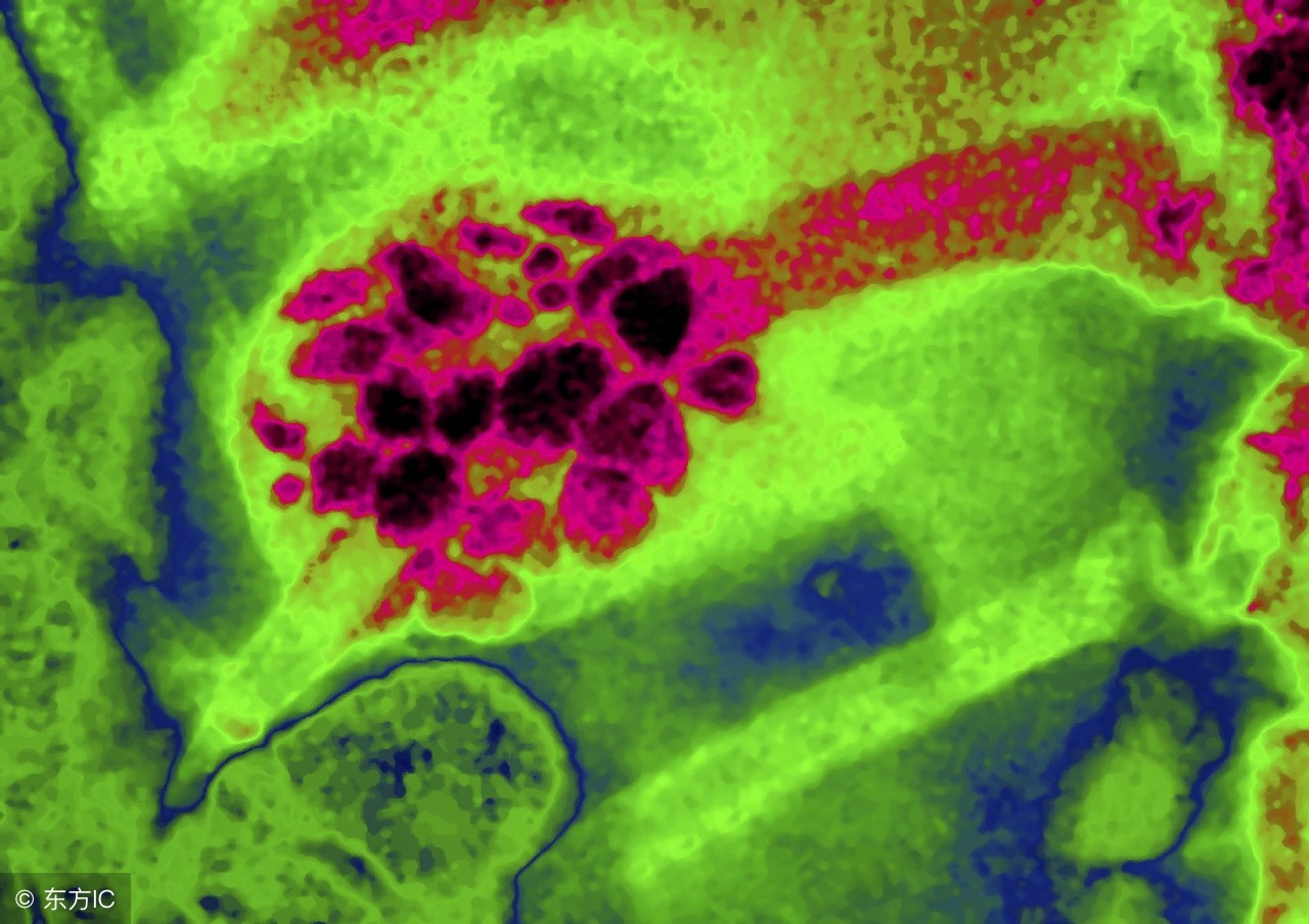 肝内胆管结石术后一般几年复发,胆管结石用ercp取石几次又复发