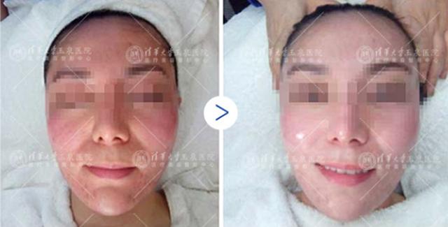 干皮用什么护肤品不容易脱妆,皮肤干燥容易过敏用什么粉底液