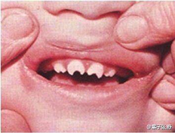 他的经历告诉你：不育的人治牙后也能有宝宝