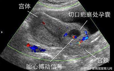 子宫破裂最主要的诱因是,怎么预防瘢痕子宫的破裂