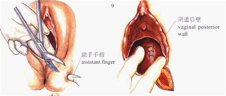 如果躲不过那就放平心态吧,侧切应该多运动还是多休息