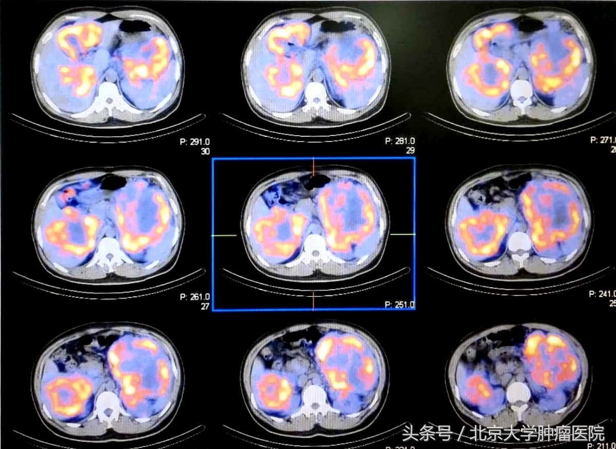 prrt治疗神经内分泌瘤价格,prrt对神经内分泌癌效果