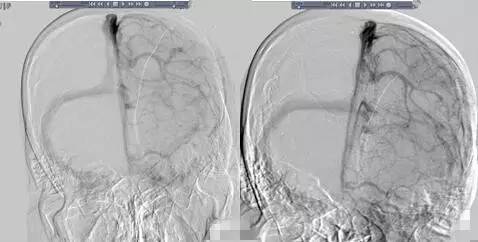 颅内静脉窦血栓ct特征,颅内静脉窦血栓的定性诊断