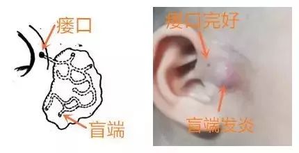 孩子耳朵长肉芽还流脓必须手术么,富贵包流血流脓是怎么回事