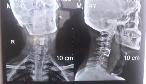 老人摔跤颈椎受损一只手臂疼,摔倒了导致颈椎脊髓损伤高位截瘫